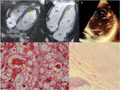 Case Report: A Rare Case of a Ventricular Perivascular Epithelioid Cell Tumor With Histologic Characteristics That Resembled a Primary Cardiac Rhabdomyoma